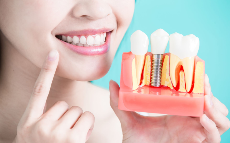 Difference Between Dental Implants And Natural Teeth