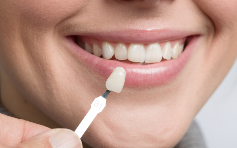 Tips to maintain porcelain veneers