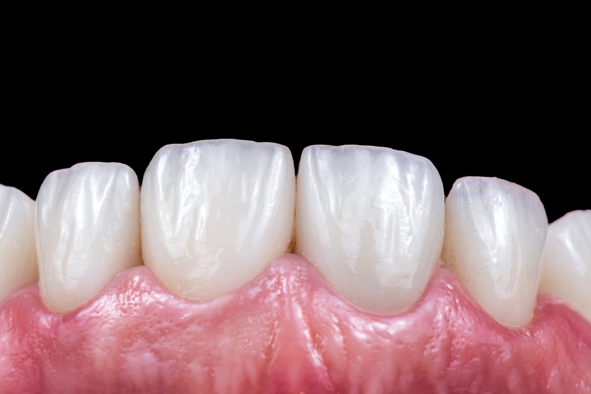 dental-veneers-in-fisherville